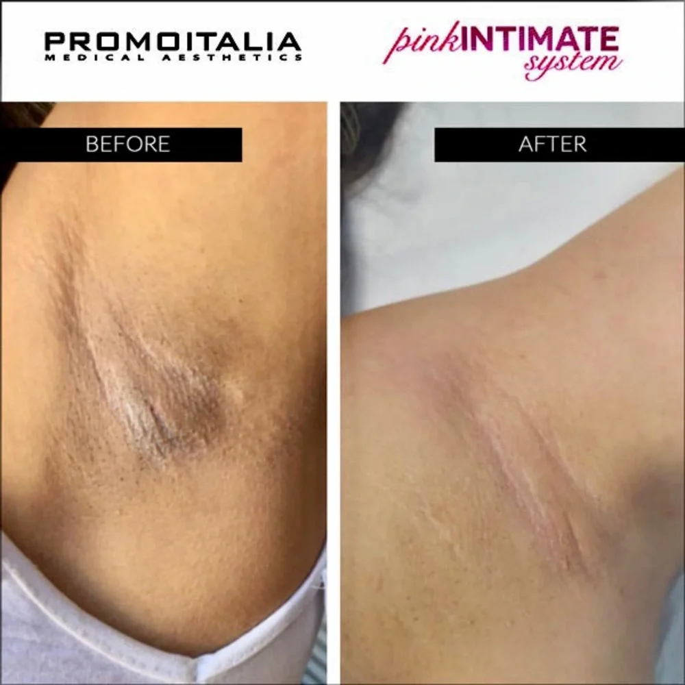 Pink Intimate System - Picture 2 of 3